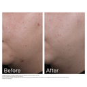 EltaMD UV Clear Blemish-Prone & Oil-Balancing 1.7oz/ 50ml