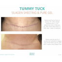 Silagen Ab/Extremity Clear Silicone Strip - 2" x 8"