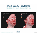Silagen Acne Scar + Spot Corrector 1oz / 30ml