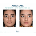 Silagen Acne Scar + Spot Corrector 1oz / 30ml