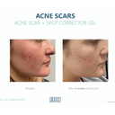 Silagen Acne Scar + Spot Corrector 1oz / 30ml